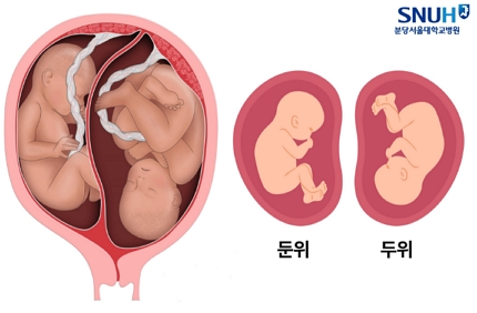 자궁 속 태아의 자세/제공= 분당서울대병원