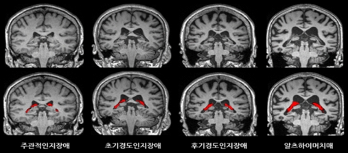 뇌 영상에서 맥락얼기의 부피(빨간색)가 치매가 진행함에 따라 더 증가한 것을 확인할 수 있다./제공=건국대병원