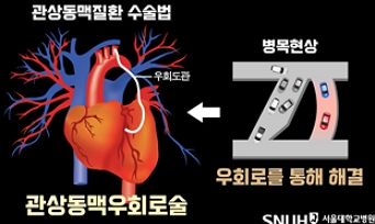 관상동맥우회로술의 원리/제공=서울대병원
