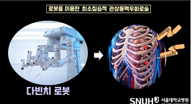 다빈치 로봇을 이용한 최소침습적 관상동맥우회로술/제공=서울대병원