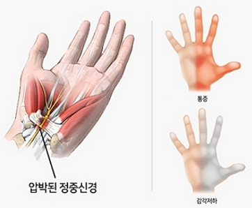 ‘손목터널 증후군’ 증상이 진행 중인 손의 모습./제공=강남베드로병원
