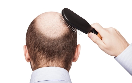 20~40대가 전체 60% 이상을 차지하며 탈모로 어려움을 겪고 있다. /게티이미지뱅크 제공