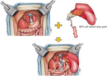 제넨바이오 이종 간이식 모식도/제공=한국보건산업진흥원