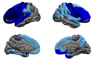 (위)대뇌의 바깥쪽 (아래)대뇌의 안쪽, 짙은 파란색일수록 뇌 주름의 정도가 감소돼 있음을 의미/제공=고려대 안암병원