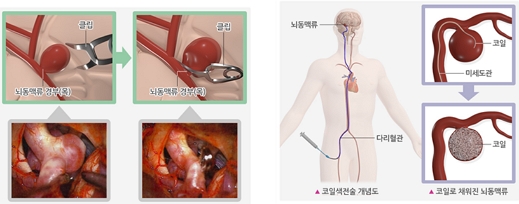 왼쪽) 뇌동맥류 경부 결찰술, 오른쪽)코일색전술의 이해/제공=중앙대병원
