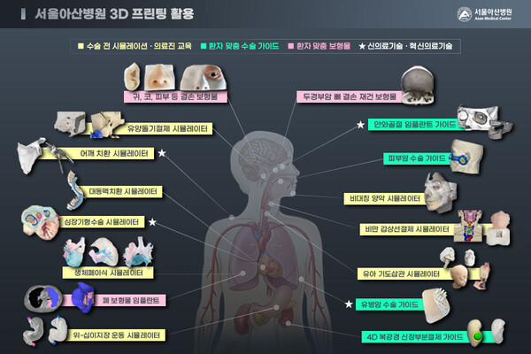 서울아산병원의 3D프린팅 활용 예시. /서울아산병원 제공