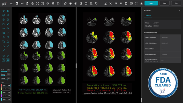 뇌졸중 솔루션 JLK-CTP./제이엘케이 제공