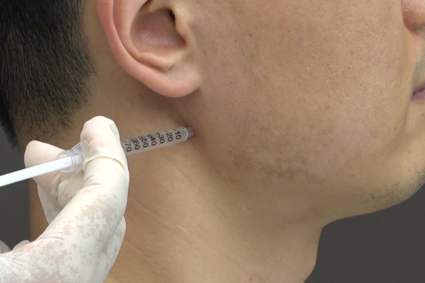 자생한방병원 의료진이 턱관절질환 약침치료를 실시하고 있다./자생한방병원 제공