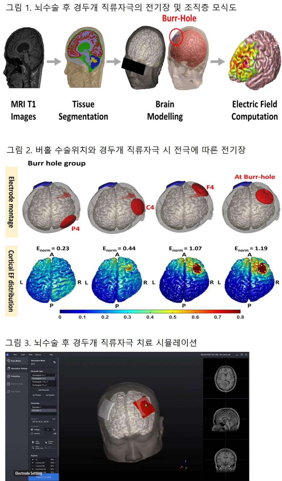 뇌수술 후 경두개 직류자극의 전기장 및 조직층 모식도./서울성모병원 제공