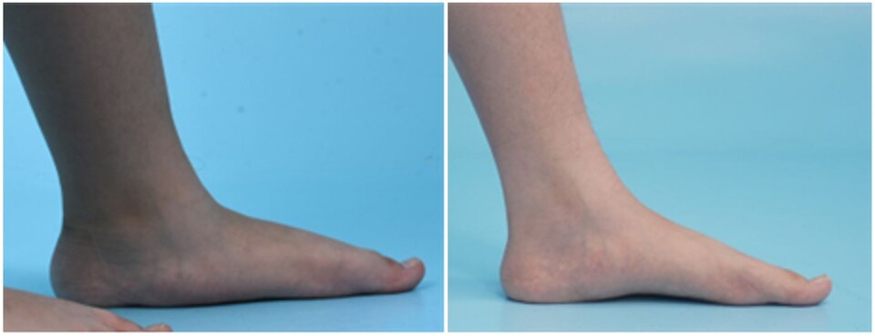 ‘종골 정지술’을 받은 환아의 수술 전(좌)과 수술 3년 후(우) 발 사진./분당서울대병원 제공