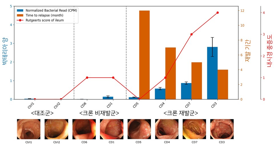 크론병 환자의 장 조직을 분석한 결과, 크론병 장 조직에서 염증이 심한 부위에서 미생물의 분포가 크게 증가하는 것으로 나타났으며, 미생물의 분포 정도가 클수록 재발 기간이 짧고, 중증도가 큰 것으로 확인됐다./연세대학교 의과대학 제공