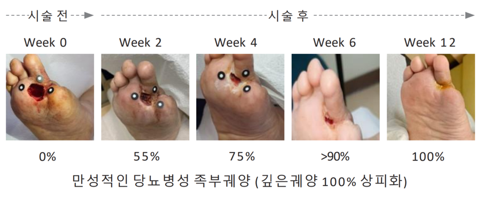  로킷헬스케어(대표 유석환)가 한국보건의료연구원으로부터 당뇨발 AI 재생치료에 대한 임상시험 시작 승인을 획득했다. /로킷헬스케어 제공