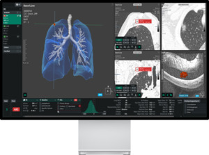 코어라인소프트, 흉부 AI로 공공의료 효율↑ - 뉴스 썸네일 이미지
